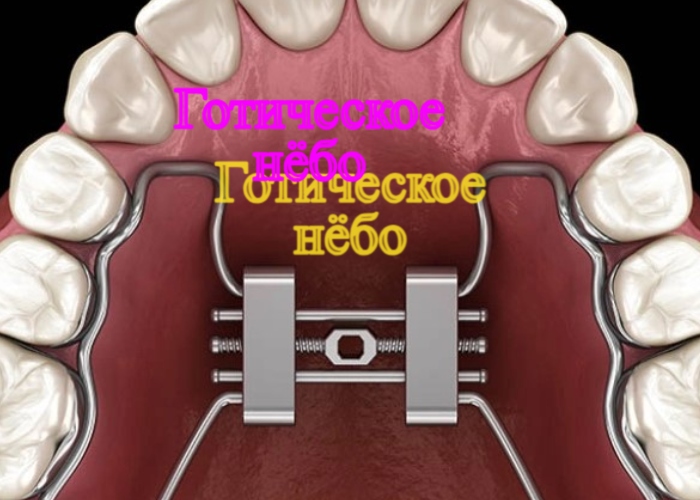 Что такое готическое нёбо